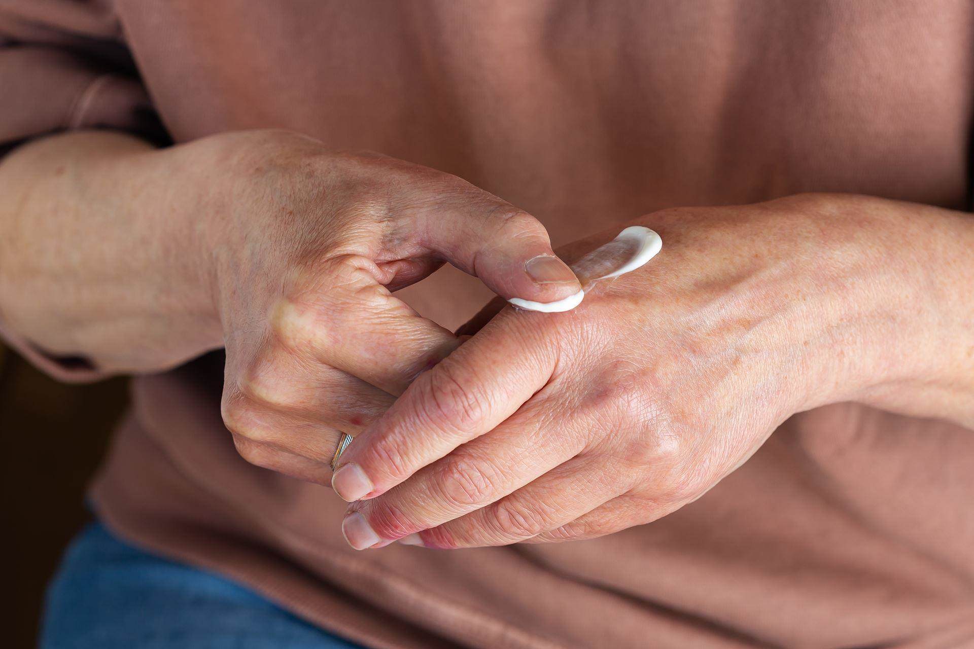 person using topical medicine on hands